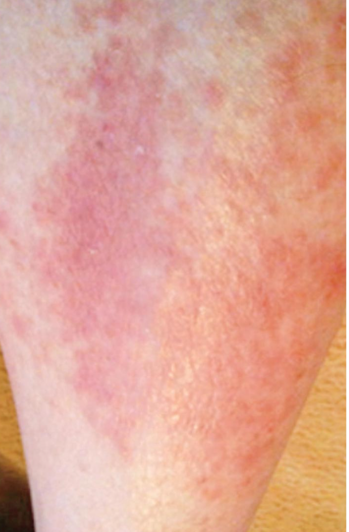 Skin inflammation close-up — before