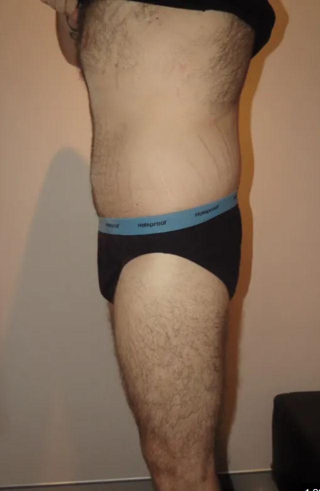 Midsection after — leaner, toned